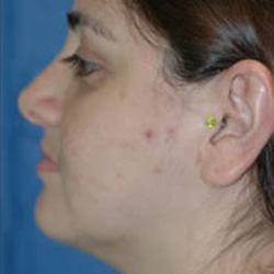 Facial Liposuction - After