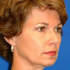 Brow & Face Lift, Rhinoplasty (Nose)