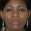 Rhinoplasty (nose)