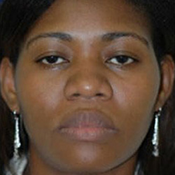 Rhinoplasty - Before