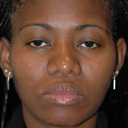 Rhinoplasty - After