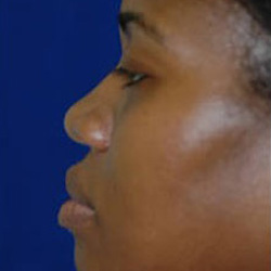 Rhinoplasty - Before