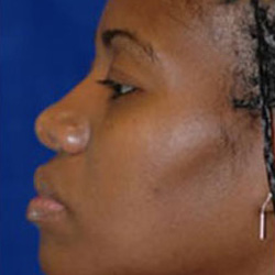Rhinoplasty - After