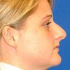 Rhinoplasty (nose)