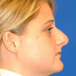 Rhinoplasty - Before