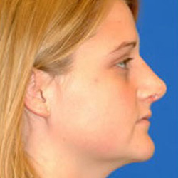 Rhinoplasty - After