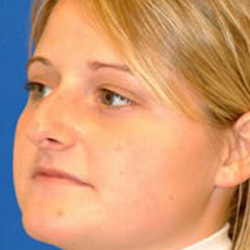 Rhinoplasty - Before