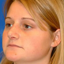Rhinoplasty - After