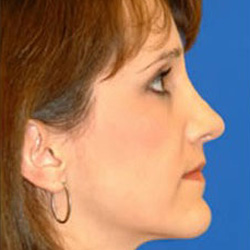 Rhinoplasty - After