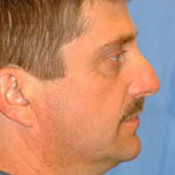 Rhinoplasty - Before