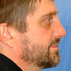 Rhinoplasty - After