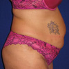 Tummy Tuck
