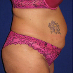 Tummy Tuck - Before
