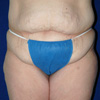 Tummy Tuck