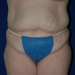 Tummy Tuck - Before