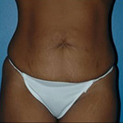 Tummy Tuck - Before