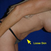 Tummy Tuck