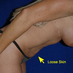 Tummy Tuck - Before